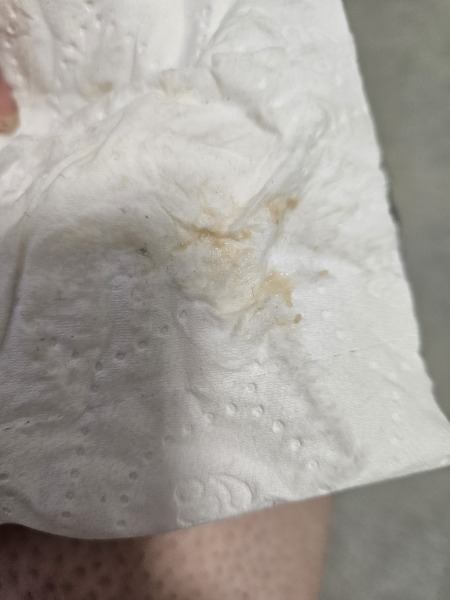 Light coloured discharge.