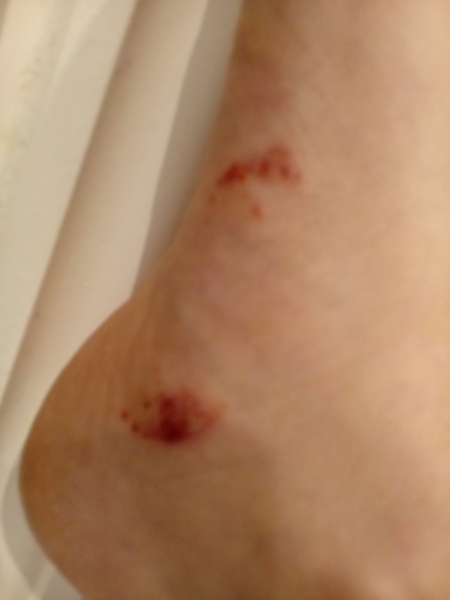 What is this foot rash?