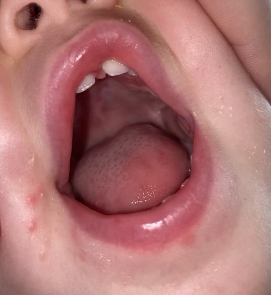 Hand, foot and mouth. Spots inside the mouth?