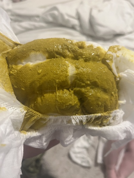 Mucus in nappy ? Sorry nappy PIC inside +