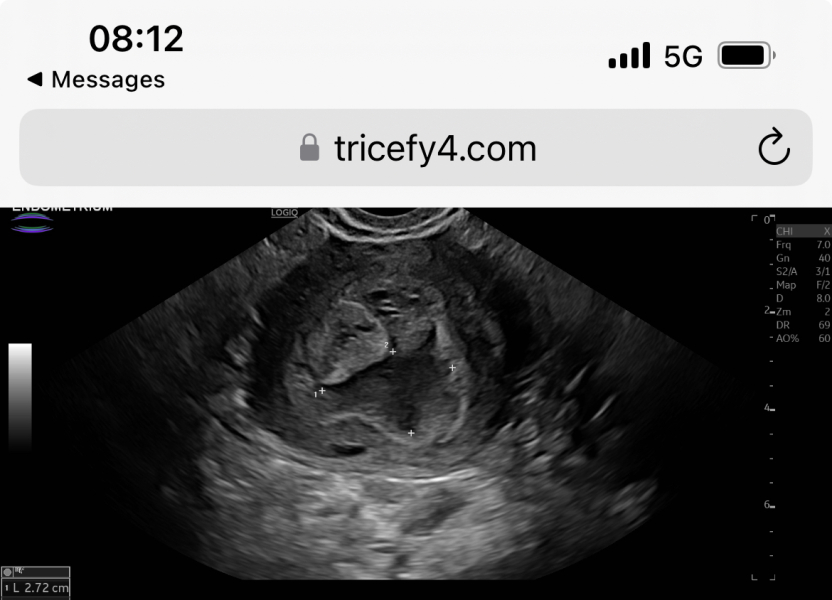 Pregnancy of Unknown Location :(