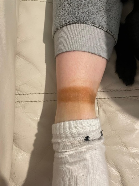 Strange 'rash' on 13 year old