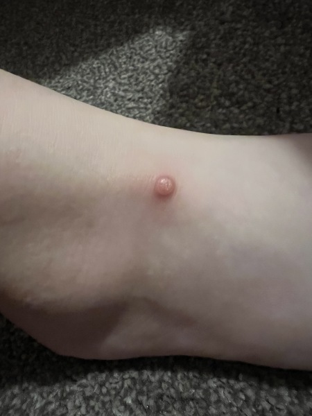 Wart or growth? What is this spot?