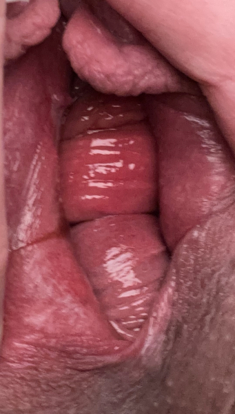 Help! Prolapse postpartum? TW picture