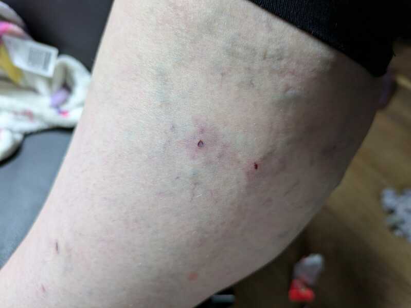 My cat has quite badly got my leg