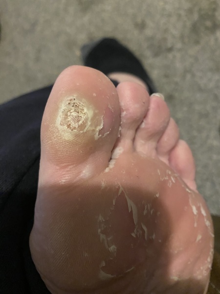 This feckin veruca (pic!)