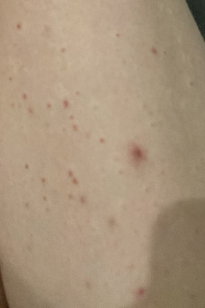 Can anyone identify this rash.....