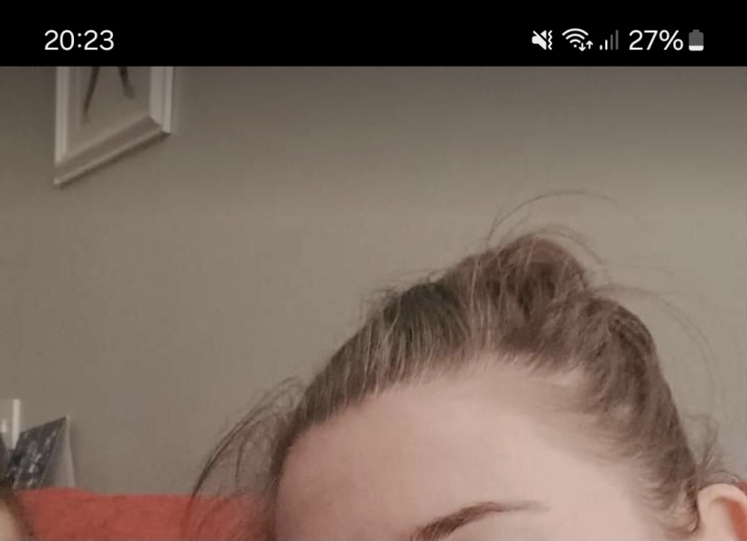 Losing hair on hairline