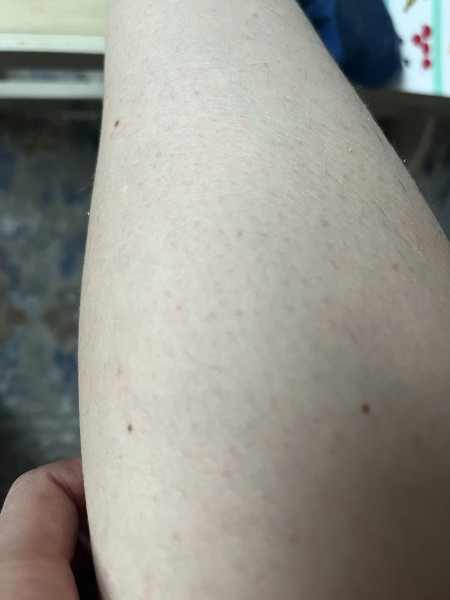 Freckles/birthmarks on legs and depilation/shaving