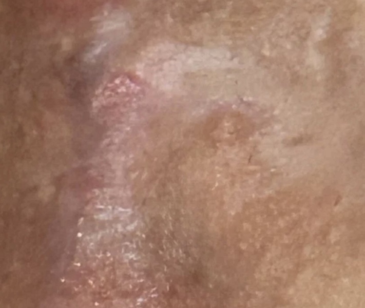 Episiotomy scar not correct