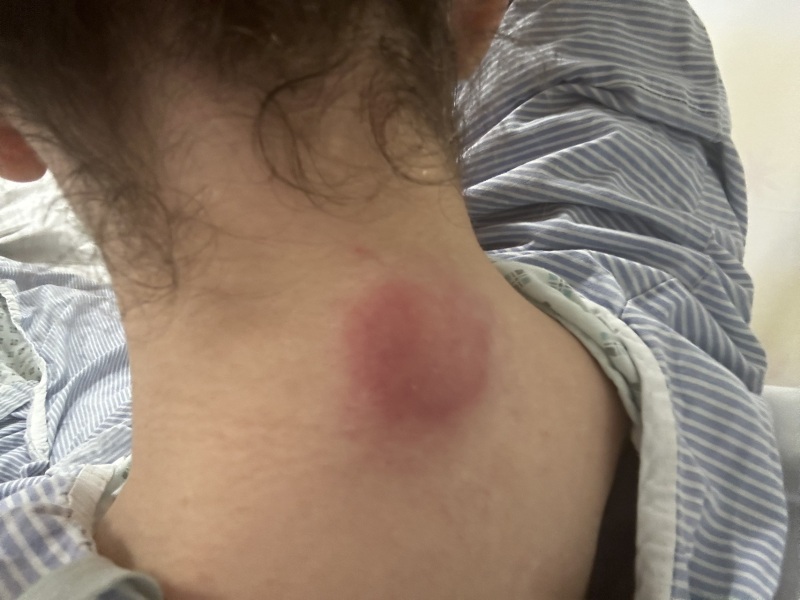 Mother of all sebaceous cysts