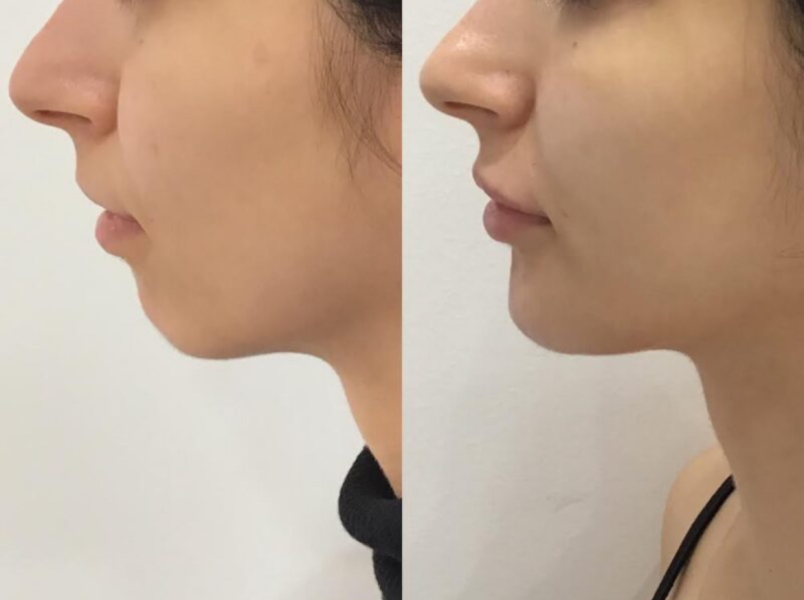 To be glad that people are realising the effects of filler!