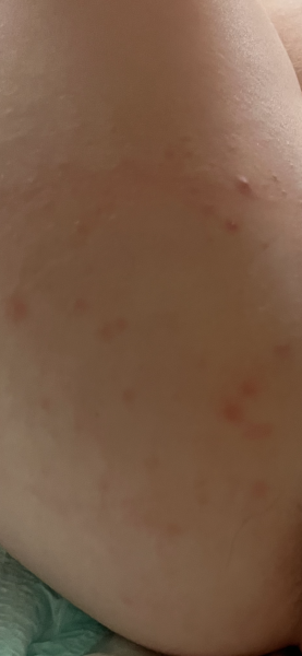 Spots on toddlers bum and a few around his mouth