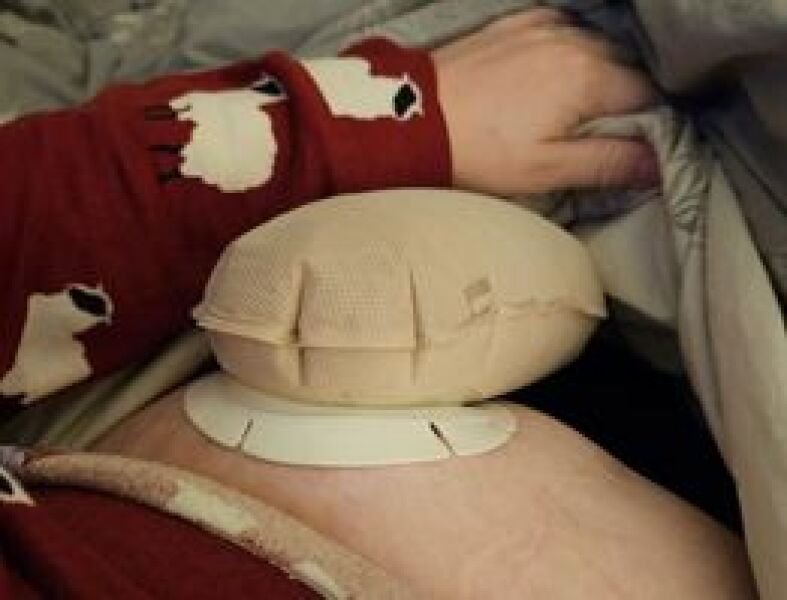 I have a stoma - AMA