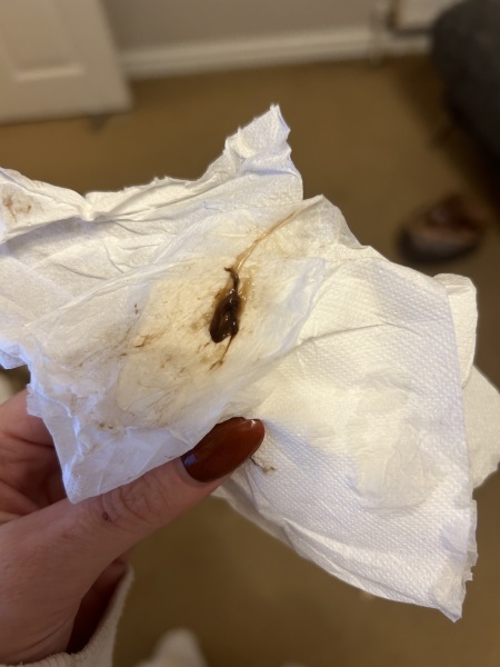 7weeks 1day pregnant- brown clot when I went to the toilet. [pic included]