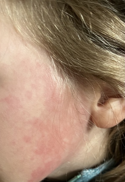 Is this slappped cheek?