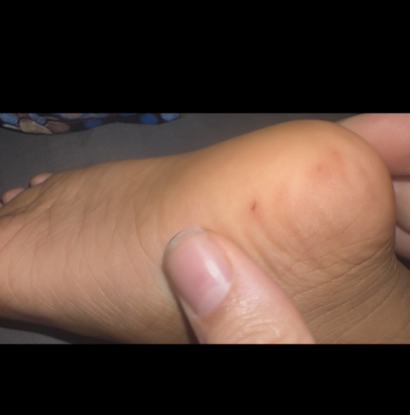 Small spots on child’s feet have turned dark
