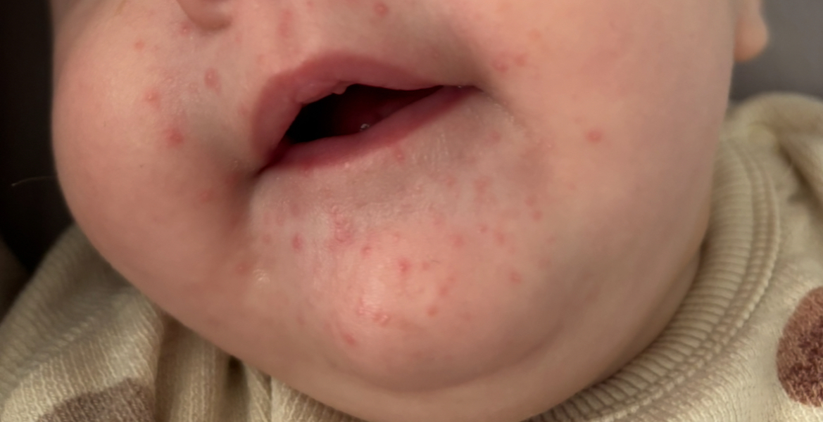 Is this dribble/drool rash (spots)?