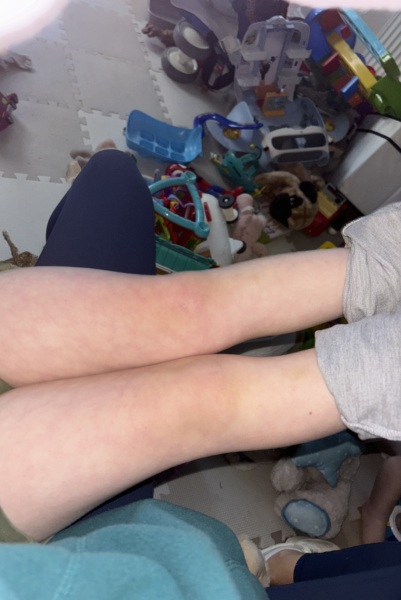 Mottled skin on toddler