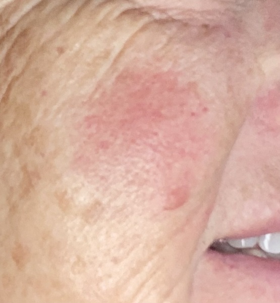 Cream for Rosacea