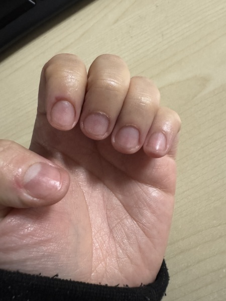 To Ask How To Stop Biting Nails