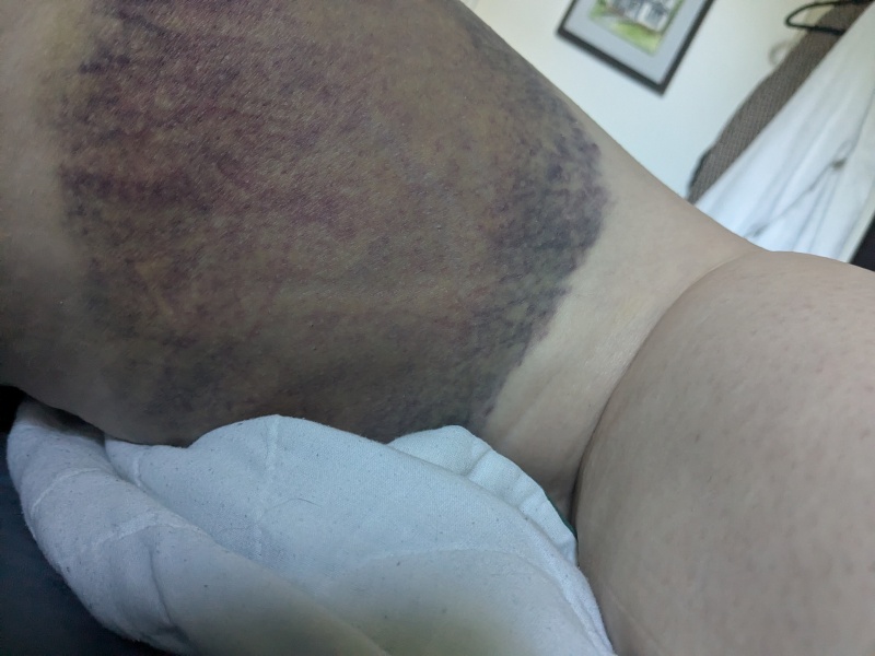 Best way to break up a huge bruise?