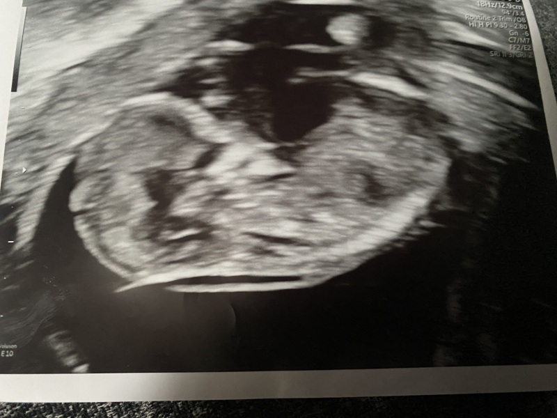 13 week scan, any ideas on sex?