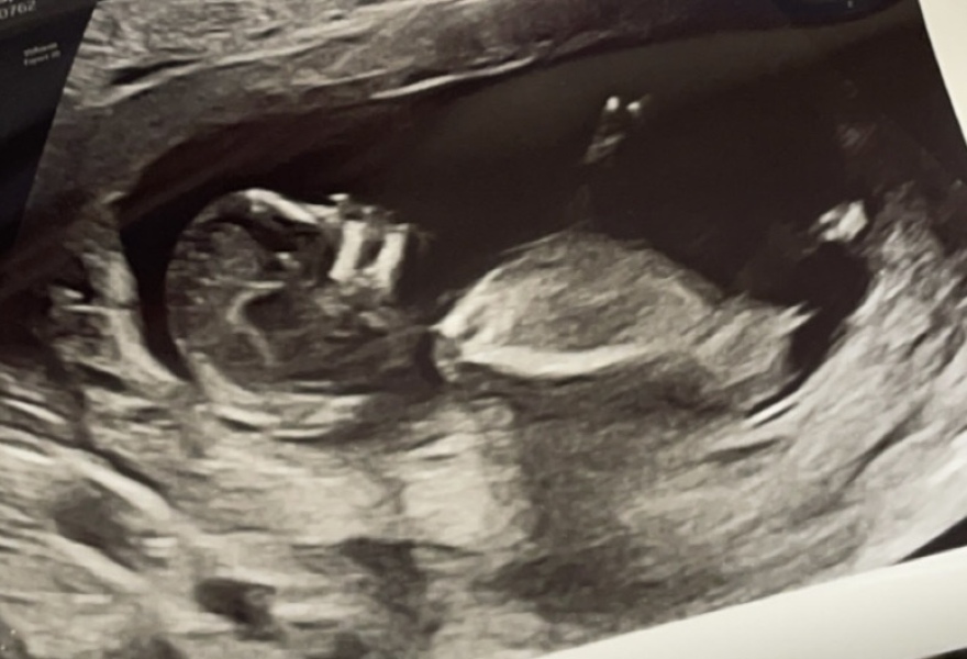 Nub theory. Thoughts? Girl or boy ?