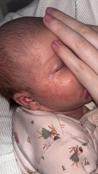 Baby acne?