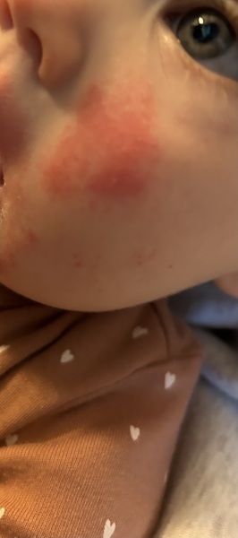 Rash on baby cheek