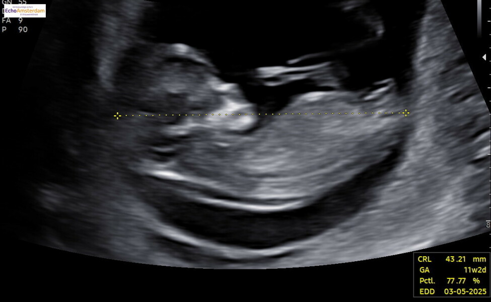 Worried about NT- 11week scan