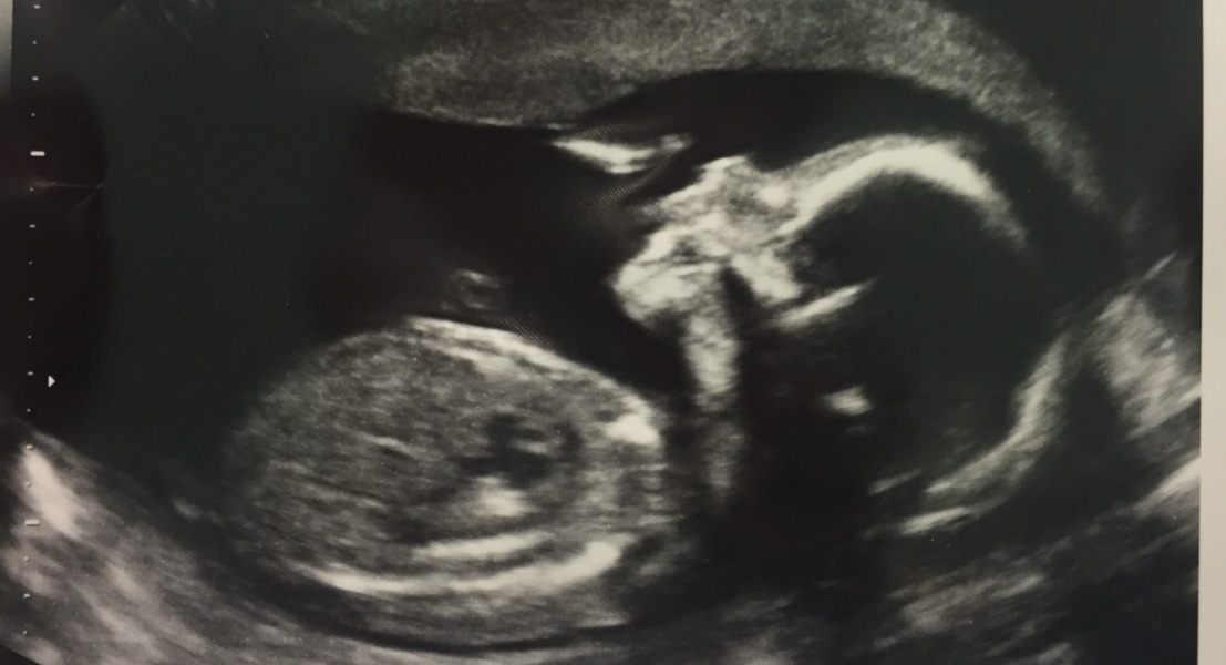 Boy or Girl?