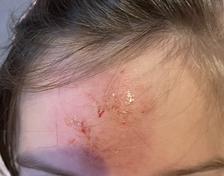 Child bumped head