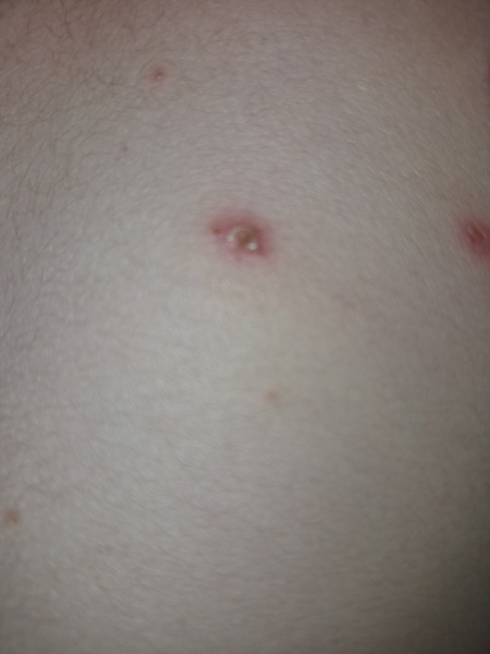 Chicken pox help please