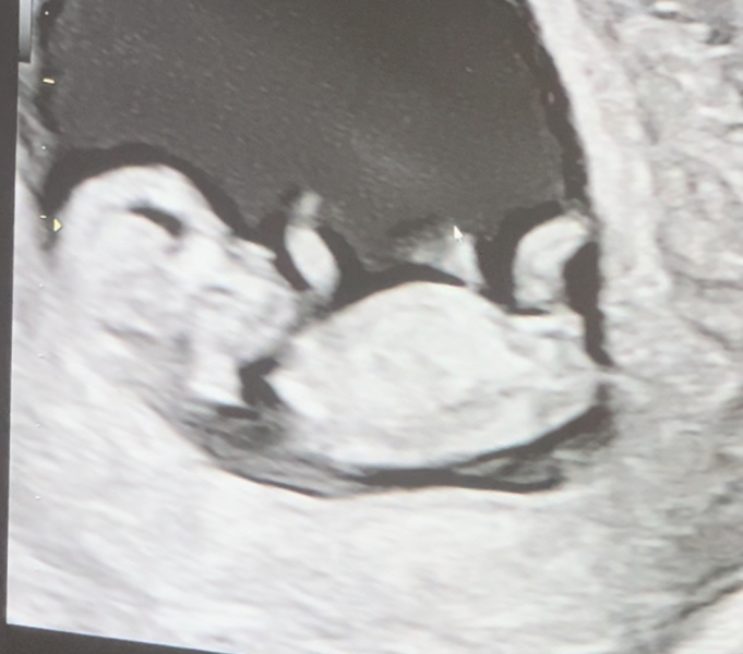 Nub theory / potty shot - boy or girl?