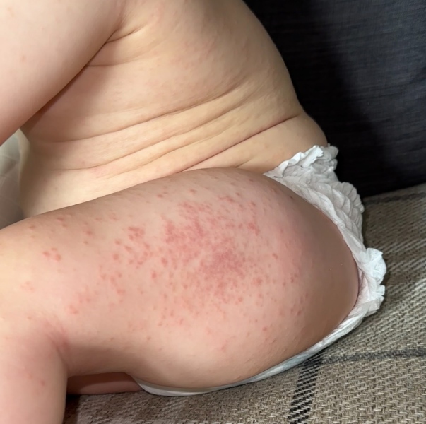Baby rash