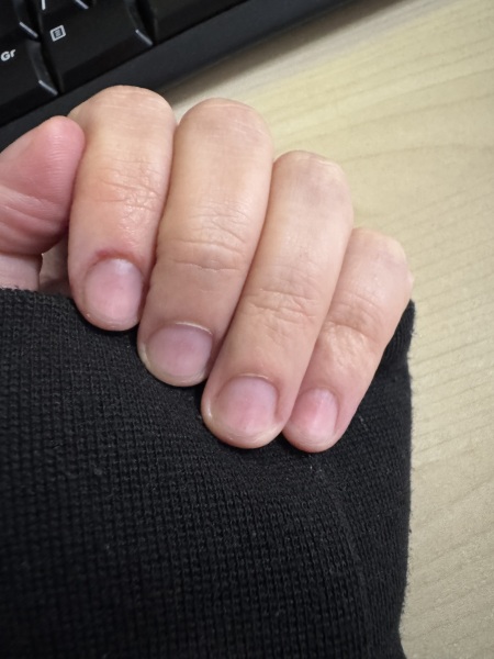 To Ask How To Stop Biting Nails