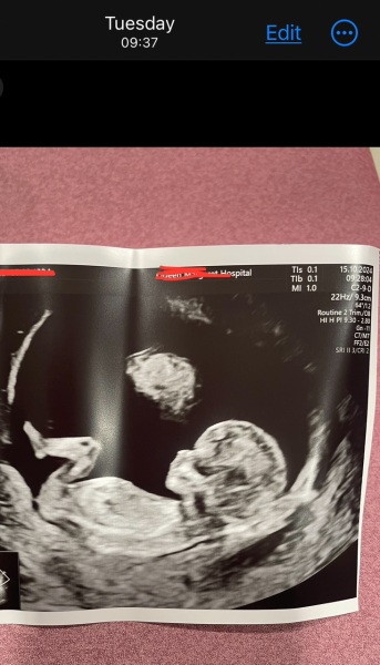 Is this my vanishing twin in my 12wk scan photo?