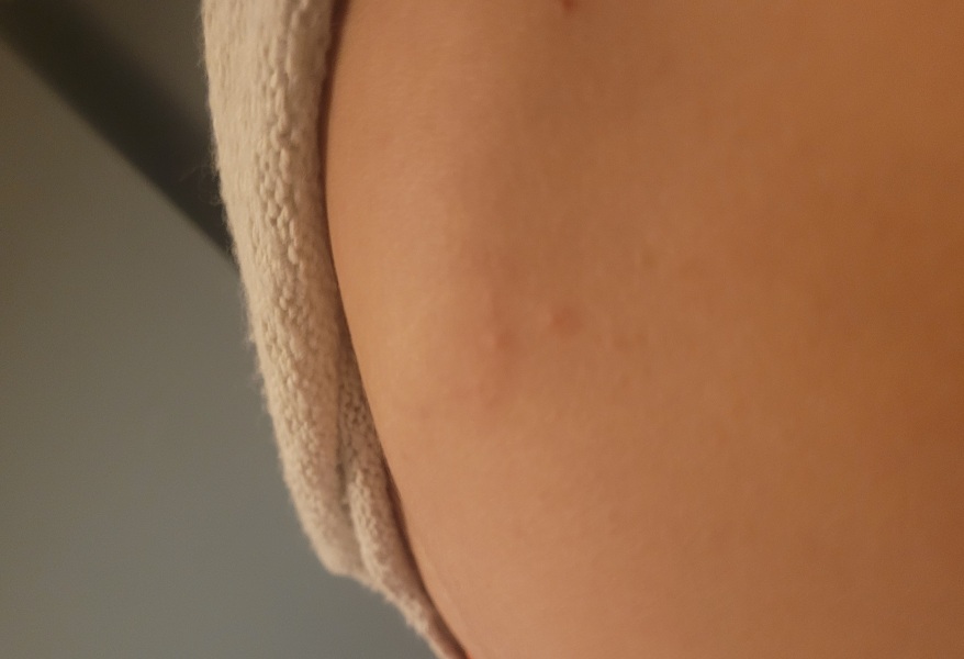 If you've had scabies
