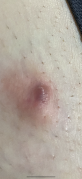 Ingrown hair