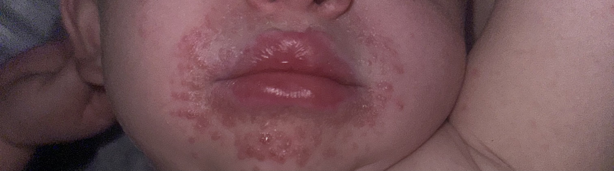 Impetigo?