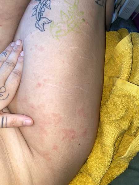 Horrible body rash!