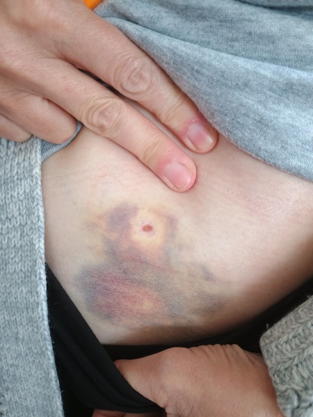 Could this be a hematoma?