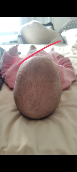 Does plagiocephaly truly get better by itself?