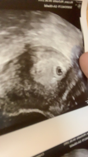 6week scan