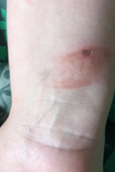 Accidentally branded/burned myself