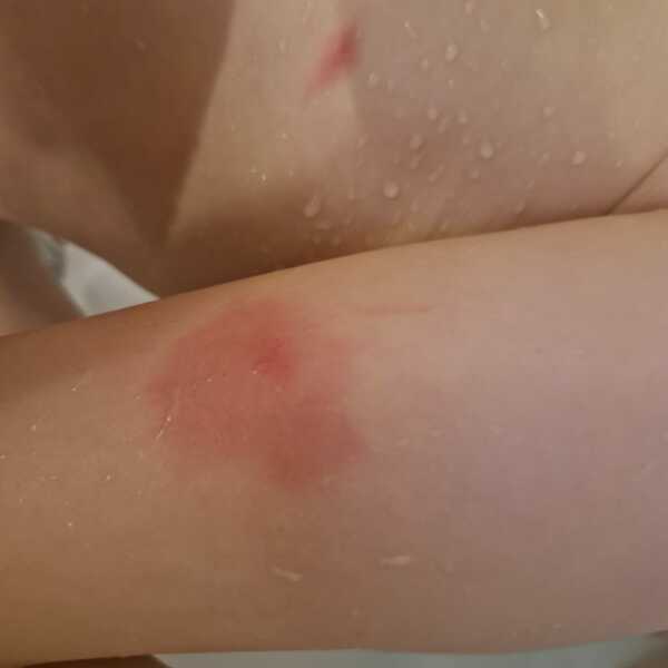 Chicken pox or bug bites