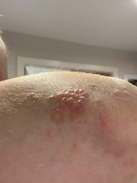 Pregnancy rash - what is this?