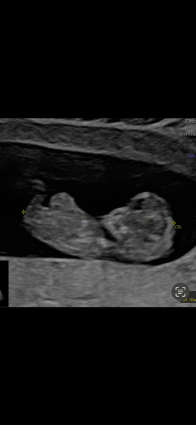 Umbilical hernia at 10w5d- really worried !