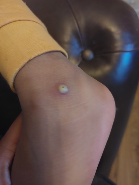 Infected chicken pox?
